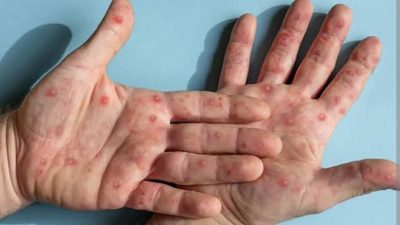 Seorang Warga Brebes Alami Gejala Klinis Cacar Monyet, Begini Cirinya