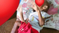 Balita Alami Gizi Buruk dan Stunting Dirawat Intensif di RSUD Batang