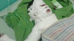 Bocah 9 Tahun Terbakar Saat Bermain Sampah, Keluarga Lapor ke Polisi